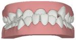 Lower teeth protrude past the front teeth