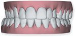 Upper and lower jaws are misaligned