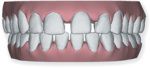 visible gaps between teeth