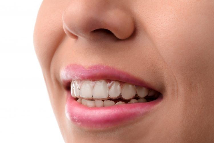 Invisalign Clear Aligners