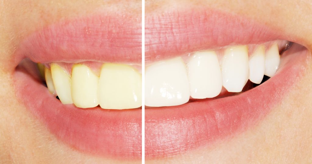 Teeth Whitening Encino