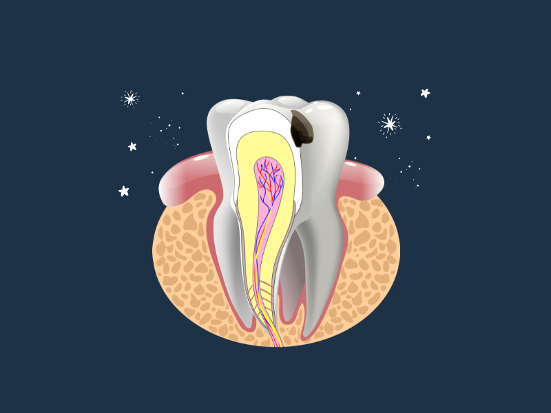Root Canal Treatment